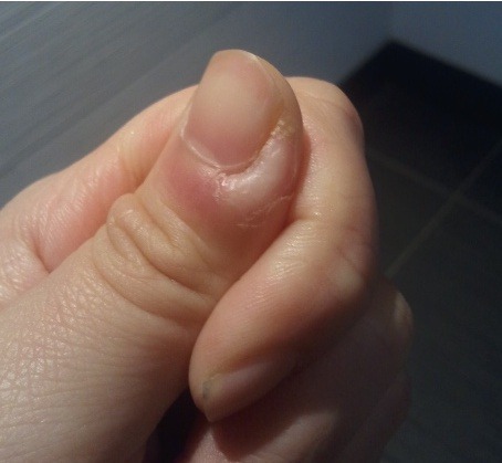 손톱 옆 거스러미 함부로 뜯으면 안되는 이유... | 인스티즈