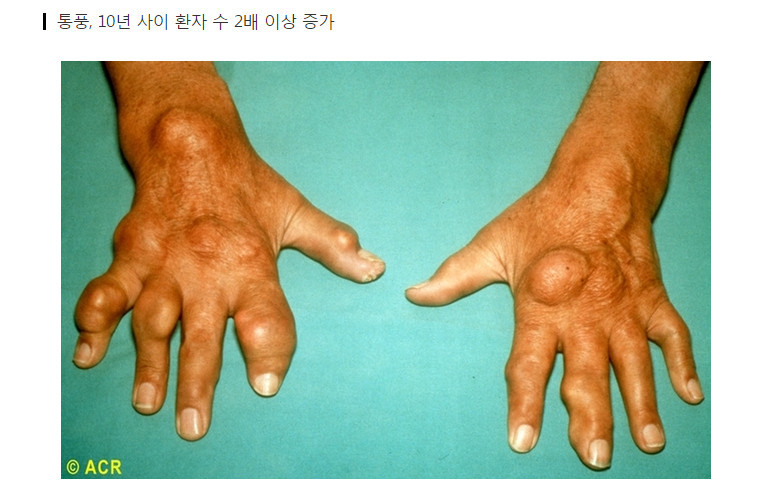 통풍 환자 40만 시대..늦은 밤 맥주 먹다 '병' 온다 | 인스티즈