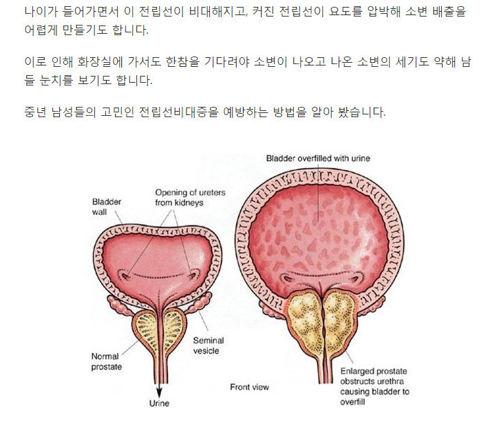 밤 잠 설치게 하는 전립선비대증..7가지 자가진단법 | 인스티즈