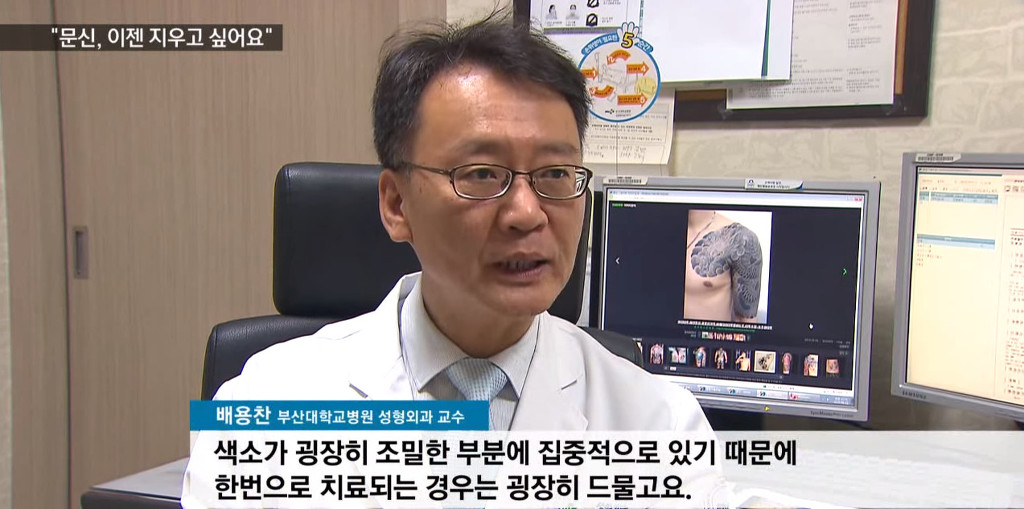 문신, 이제 지우고 싶어요! | 인스티즈